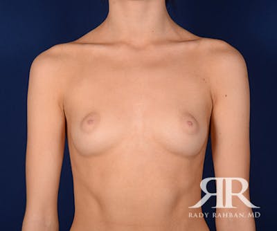 Breast Augmentation Before & After Gallery - Patient 202526 - Image 1