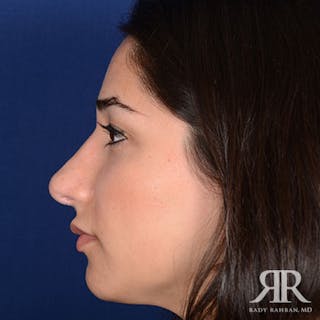 Ethnic Rhinoplasty Before & After Gallery - Patient 215578 - Image 6