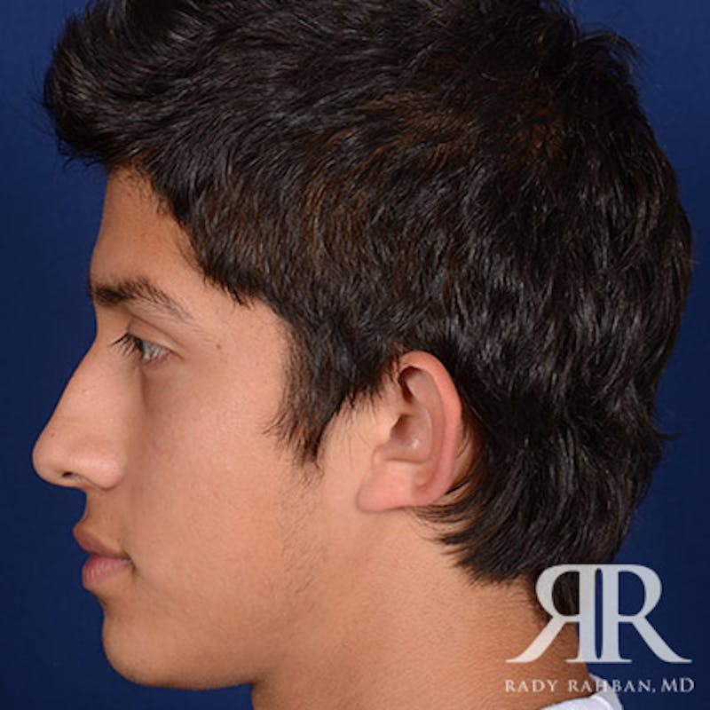 Ear Pinning Surgery Before & After Gallery - Patient 269906 - Image 5