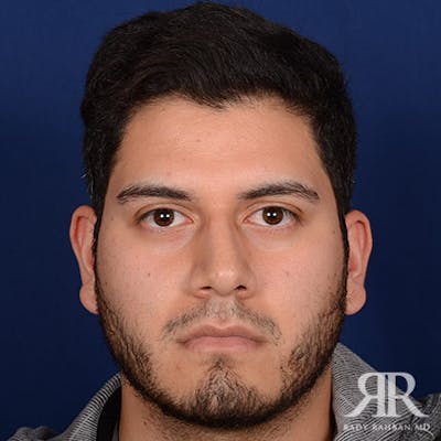 Male Rhinoplasty Before & After Gallery - Patient 378609 - Image 1