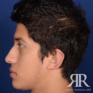 Ear Pinning Surgery Before & After Gallery - Patient 269906 - Image 6