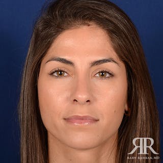 Female Rhinoplasty Before & After Gallery - Patient 279427 - Image 2