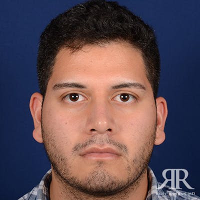 Male Rhinoplasty Before & After Gallery - Patient 378609 - Image 2