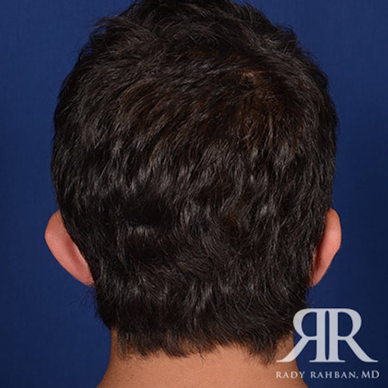 Ear Pinning Surgery Before & After Gallery - Patient 269906 - Image 7