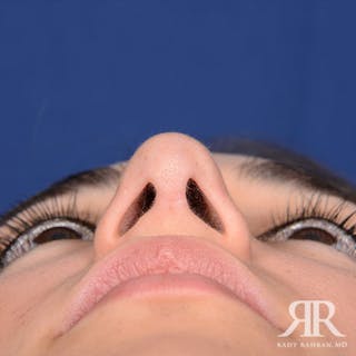 Ethnic Rhinoplasty Before & After Gallery - Patient 215578 - Image 8