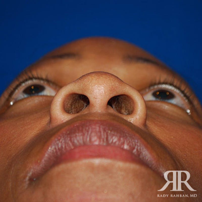 Rhinoplasty w/ Chin Implant Before & After Gallery - Patient 330943 - Image 5