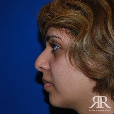 Corrective / Revision Rhinoplasty Before & After Gallery - Patient 692839 - Image 1