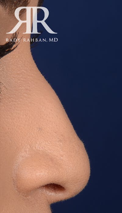 Rhinoplasty Close Up Before & After Gallery - Patient 419005 - Image 1