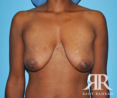 Breast Lift Before & After Gallery - Patient 108190 - Image 1