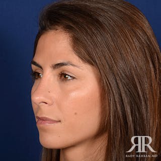 Female Rhinoplasty Before & After Gallery - Patient 279427 - Image 4