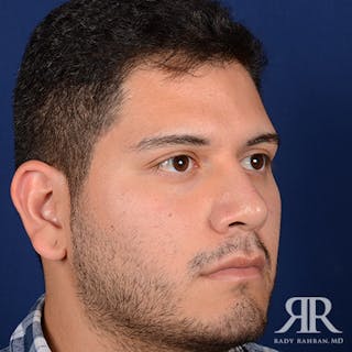 Male Rhinoplasty Before & After Gallery - Patient 378609 - Image 4