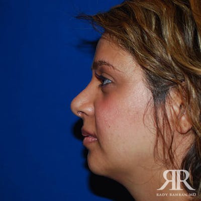 Corrective / Revision Rhinoplasty Before & After Gallery - Patient 692839 - Image 2