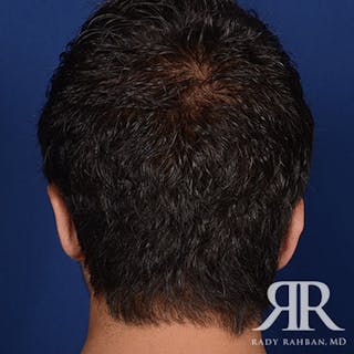 Ear Pinning Surgery Before & After Gallery - Patient 269906 - Image 8