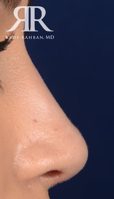 Rhinoplasty Close Up Before & After Gallery - Patient 419005 - Image 2