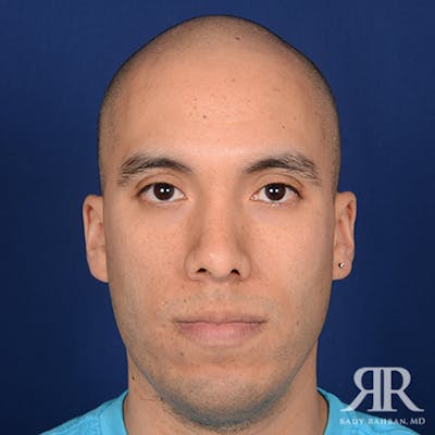 Corrective / Revision Rhinoplasty Before & After Gallery - Patient 291048 - Image 1