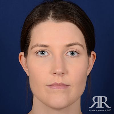 Ear Pinning Surgery Before & After Gallery - Patient 387416 - Image 1