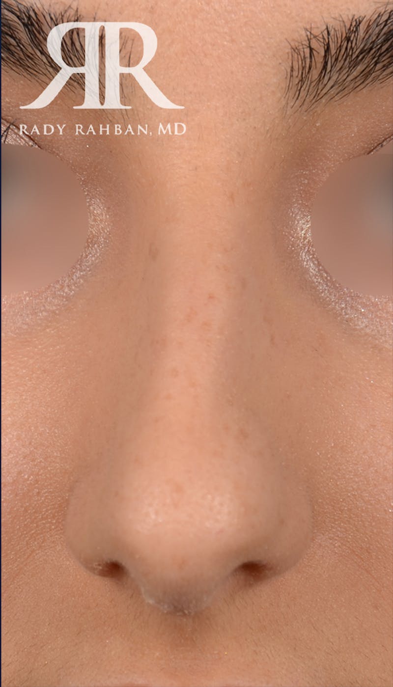 Rhinoplasty Close Up Before & After Gallery - Patient 419005 - Image 3
