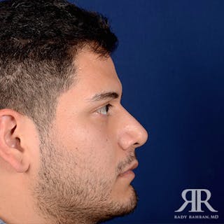 Male Rhinoplasty Before & After Gallery - Patient 378609 - Image 6