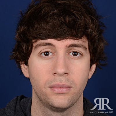 Rhinoplasty w/ Chin Implant Before & After Gallery - Patient 177254 - Image 2