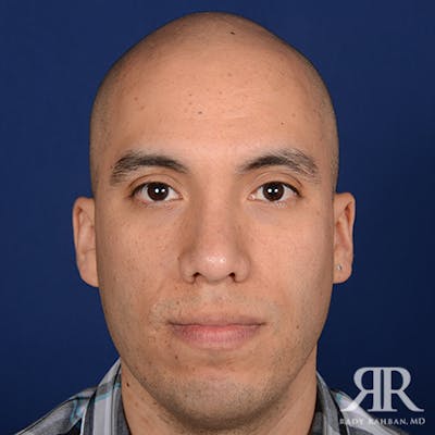 Corrective / Revision Rhinoplasty Before & After Gallery - Patient 291048 - Image 2