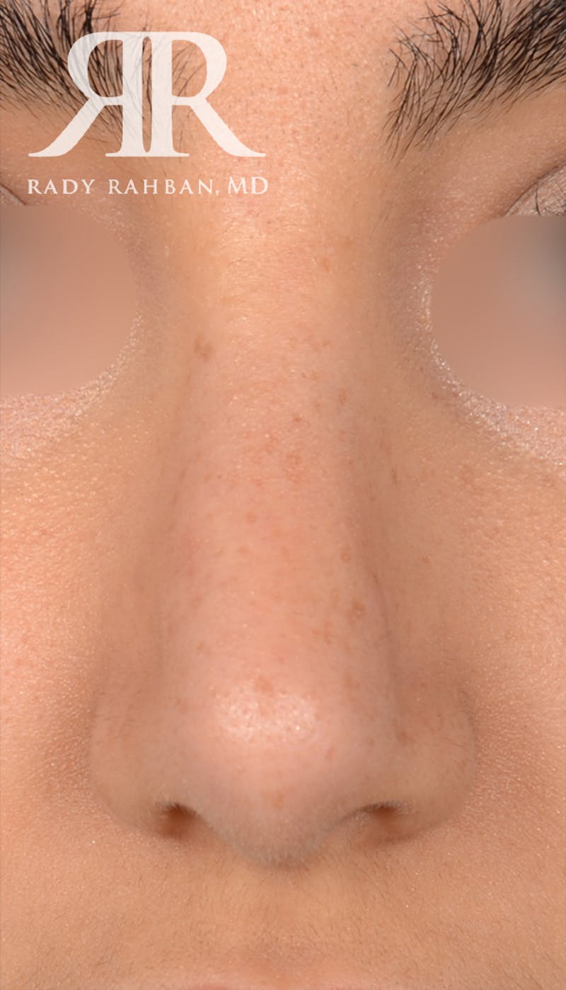 Rhinoplasty Close Up Before & After Gallery - Patient 419005 - Image 4