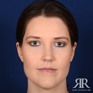 Ear Pinning Surgery Before & After Gallery - Patient 387416 - Image 2