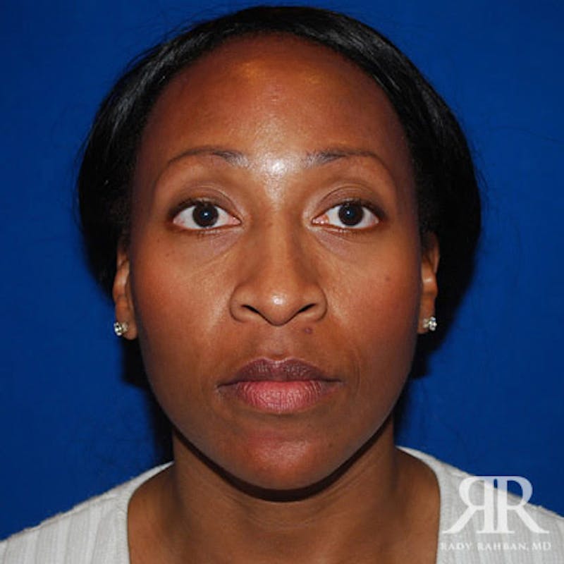 Female Rhinoplasty Before & After Gallery - Patient 329942 - Image 1