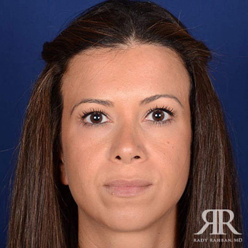 Chin Augmentation Before & After Gallery - Patient 191581 - Image 1
