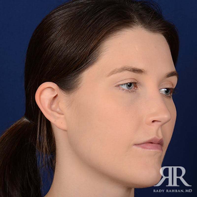 Ear Pinning Surgery Before & After Gallery - Patient 387416 - Image 3