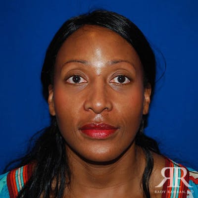 Female Rhinoplasty Before & After Gallery - Patient 329942 - Image 2