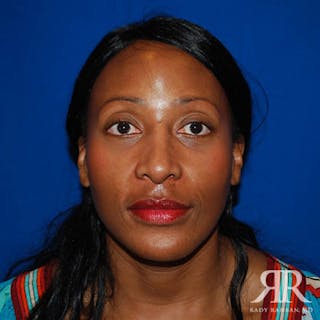 Female Rhinoplasty Before & After Gallery - Patient 329942 - Image 2
