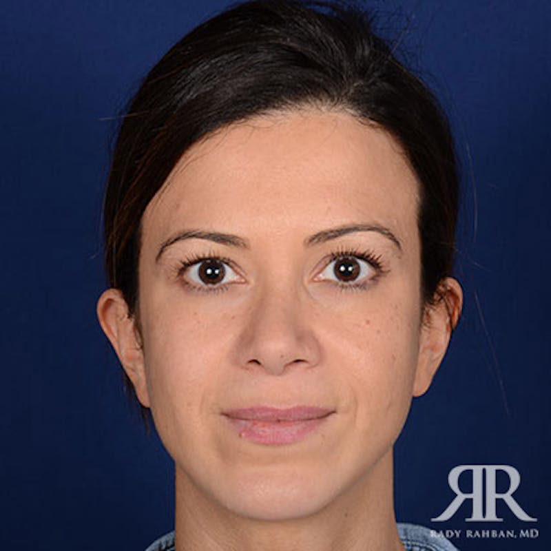 Before and after patient results
