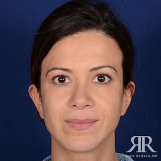 Chin Augmentation Before & After Gallery - Patient 191581 - Image 2