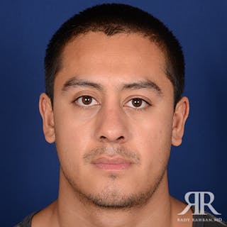 Male Rhinoplasty Before & After Gallery - Patient 169298 - Image 2