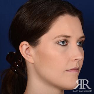 Ear Pinning Surgery Before & After Gallery - Patient 387416 - Image 4
