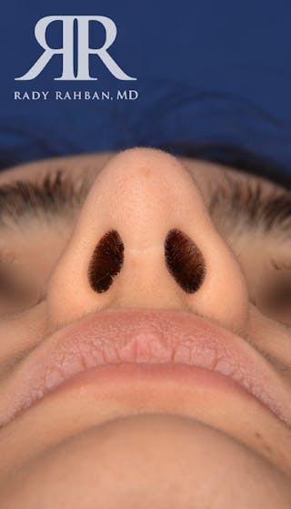 Rhinoplasty Close Up Before & After Gallery - Patient 419005 - Image 6