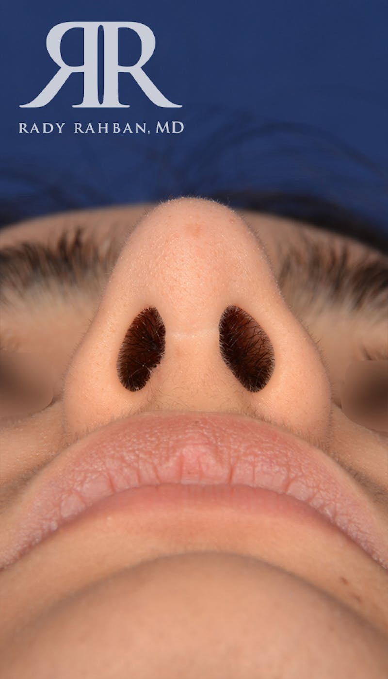 Rhinoplasty Close Up Before & After Gallery - Patient 419005 - Image 6