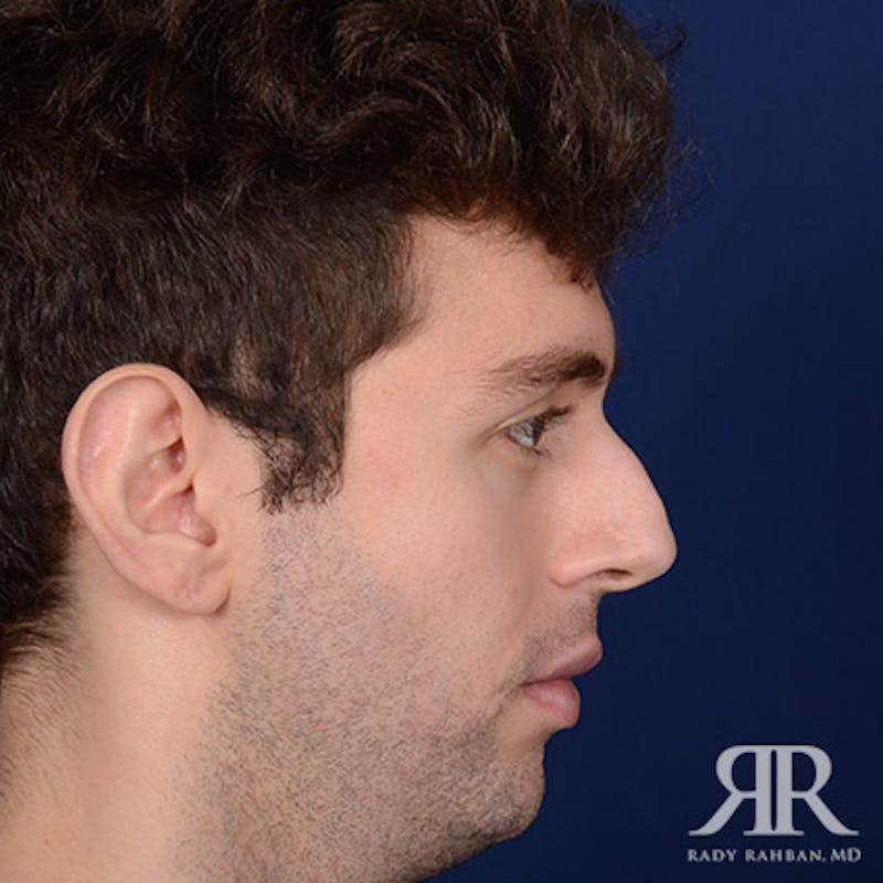 Rhinoplasty w/ Chin Implant Before & After Gallery - Patient 177254 - Image 5