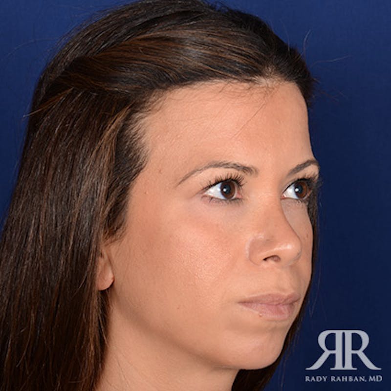 Chin Augmentation Before & After Gallery - Patient 191581 - Image 3