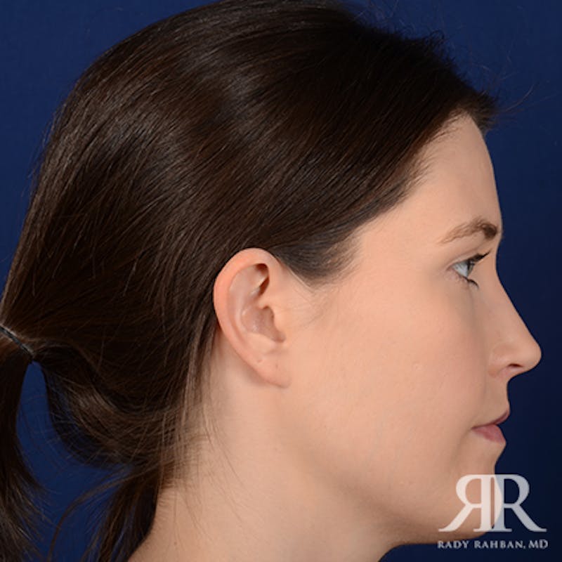 Ear Pinning Surgery Before & After Gallery - Patient 387416 - Image 5
