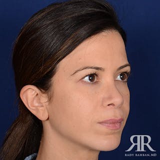 Chin Augmentation Before & After Gallery - Patient 191581 - Image 4
