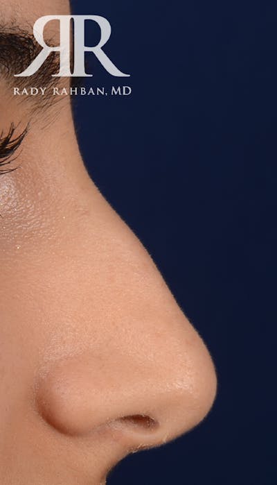 Rhinoplasty Close Up Before & After Gallery - Patient 396865 - Image 1