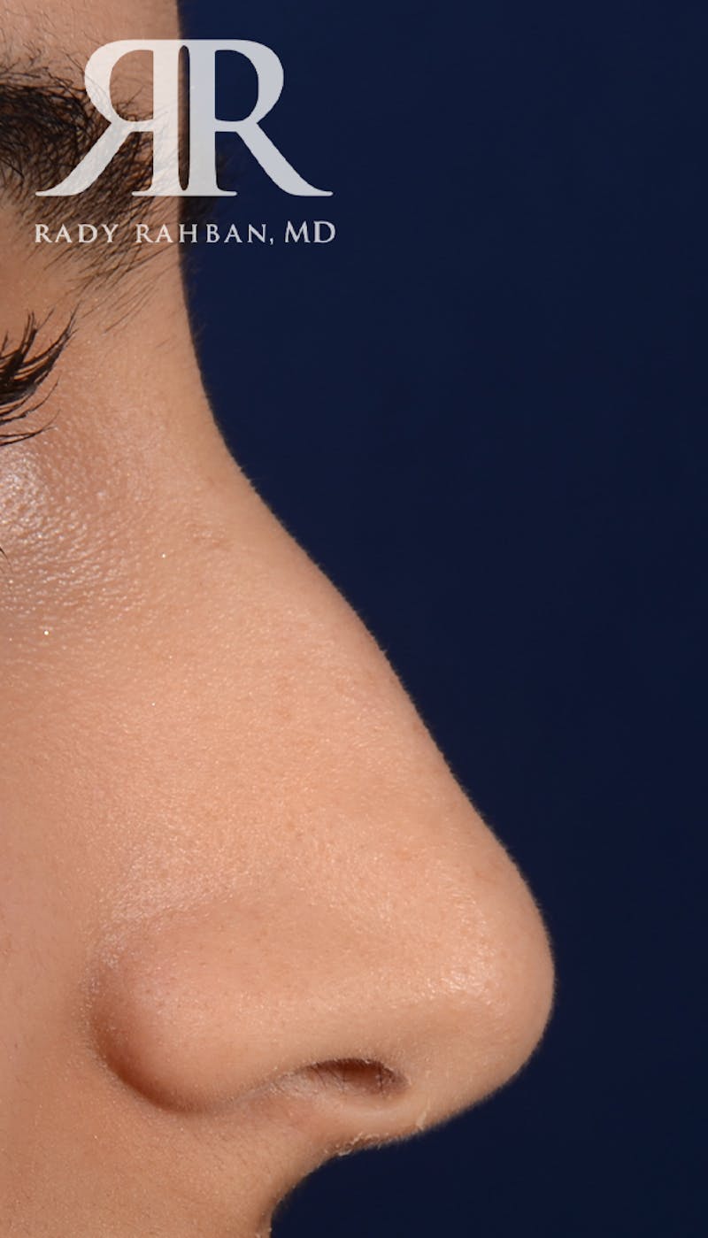 Rhinoplasty Close Up Before & After Gallery - Patient 396865 - Image 1