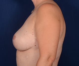 Breast Reduction Before & After Gallery - Patient 117247 - Image 6