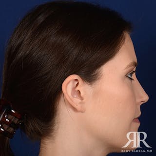 Ear Pinning Surgery Before & After Gallery - Patient 387416 - Image 6
