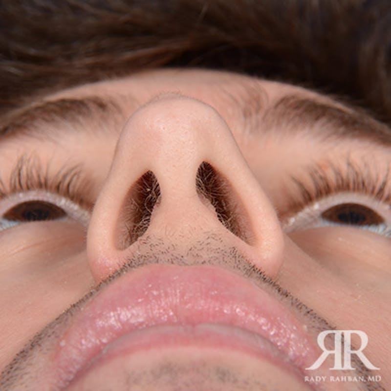 Rhinoplasty w/ Chin Implant Before & After Gallery - Patient 177254 - Image 7