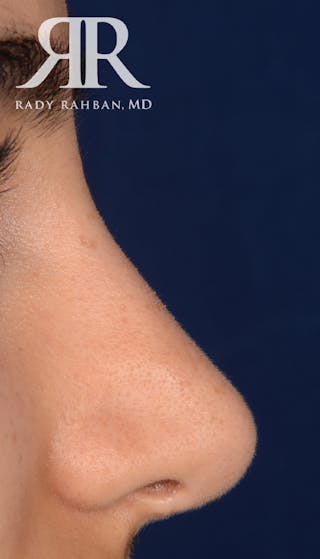 Rhinoplasty Close Up Before & After Gallery - Patient 396865 - Image 2