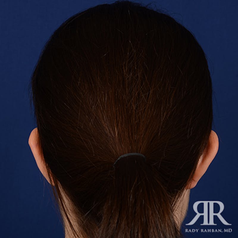 Ear Pinning Surgery Before & After Gallery - Patient 387416 - Image 7