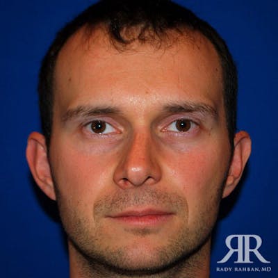 Corrective / Revision Rhinoplasty Before & After Gallery - Patient 310682 - Image 1