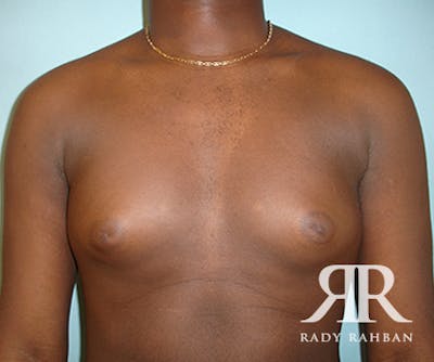 Male Breast Reduction Before & After Gallery - Patient 296372 - Image 1